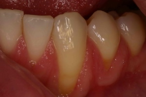 zubnomeso1