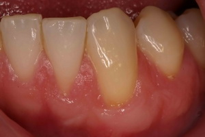 zubnomeso2